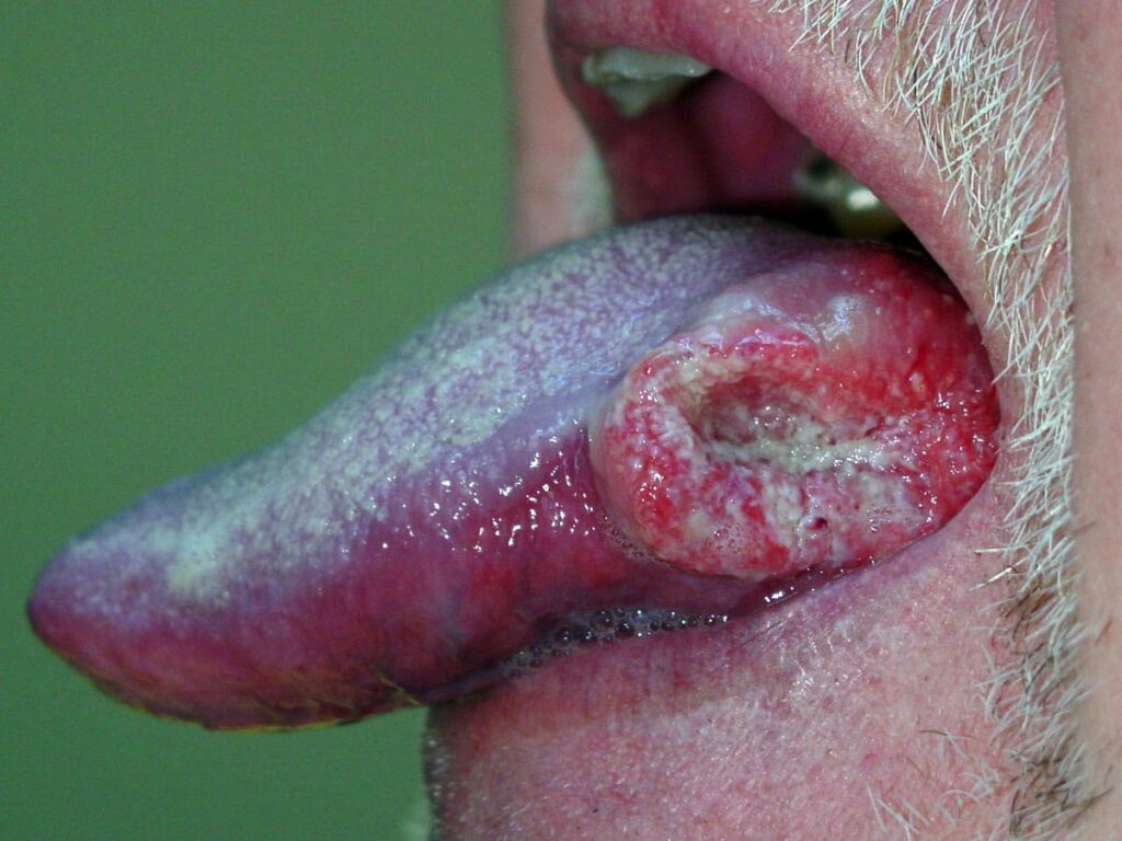 20071112 oral cancer