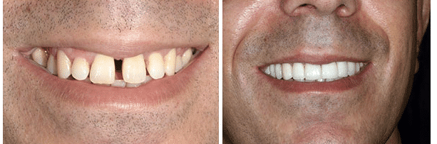 Before and after images showcasing teeth transformation following dental treatment