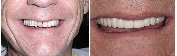 Before and after images of a man's smile transformation dental treatment performed by Dr. Nottingham