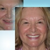 dental facelift