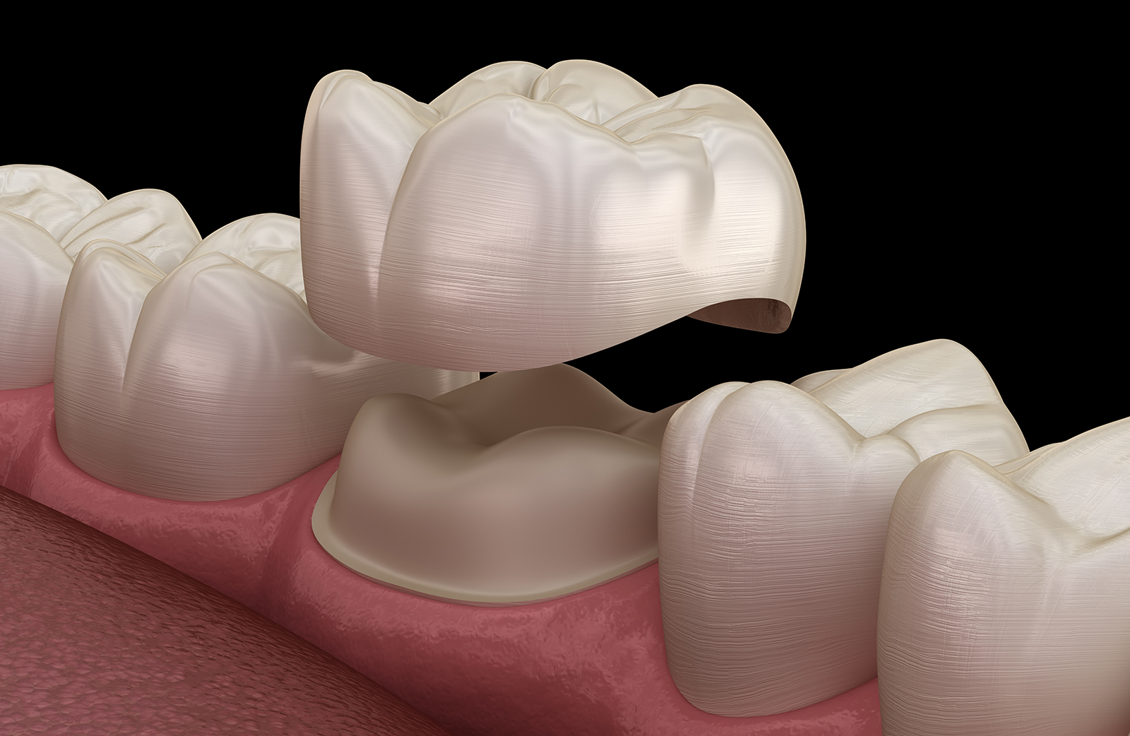 dental crowns