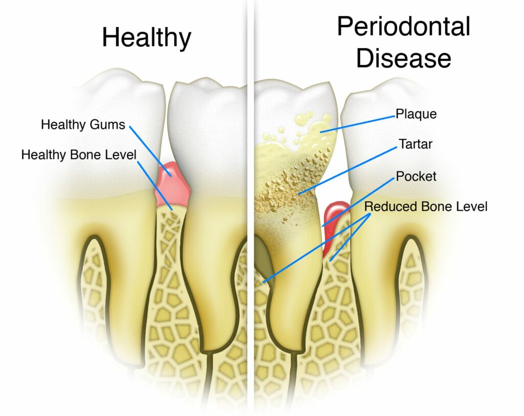 gum disease new