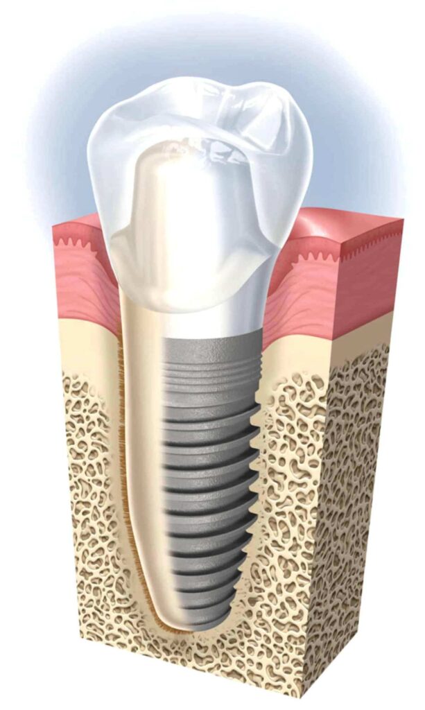 implant animation