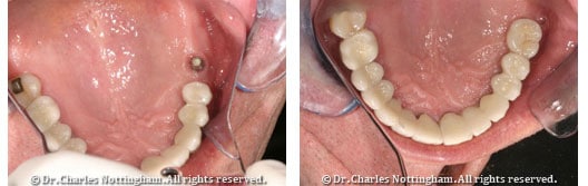 Before and after images showcasing teeth transformation following dental treatment