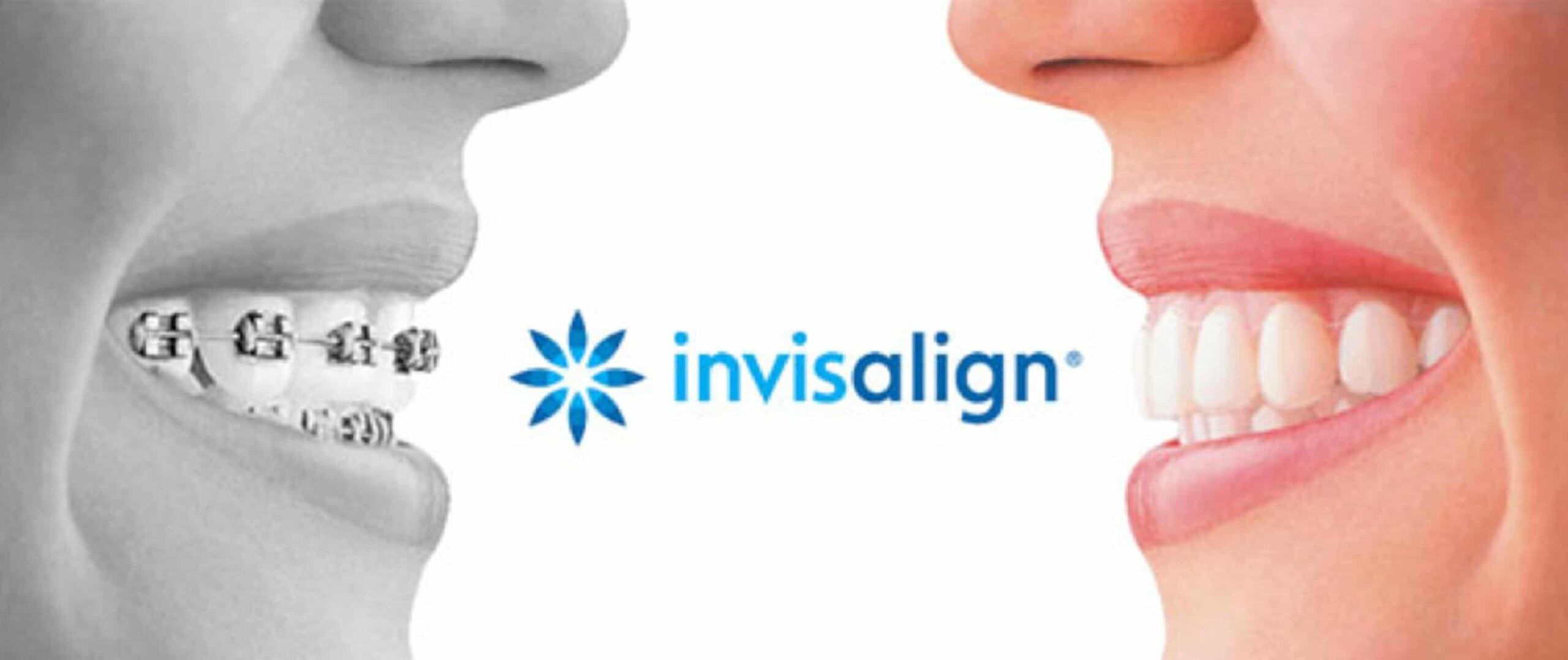 invisalign2345 scaled