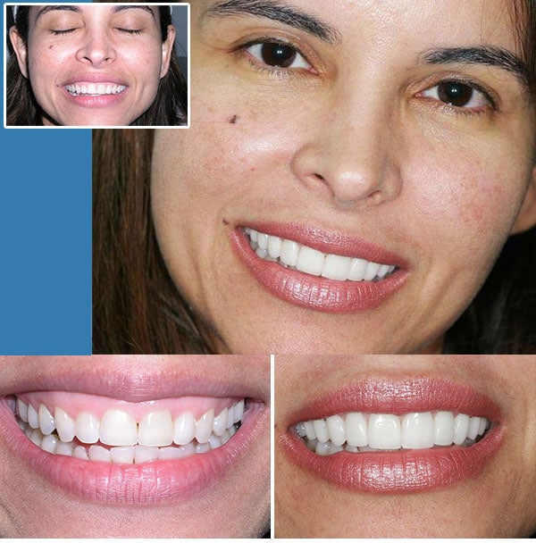 Before and after images of a woman's smile transformation dental treatment performed by Dr. Nottingham