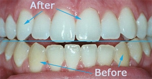 Before and after images showcasing teeth transformation following dental treatment