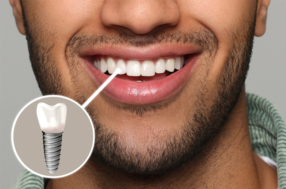 happy man with perfect teeth smiling on grey background closeup illustration of dental implant