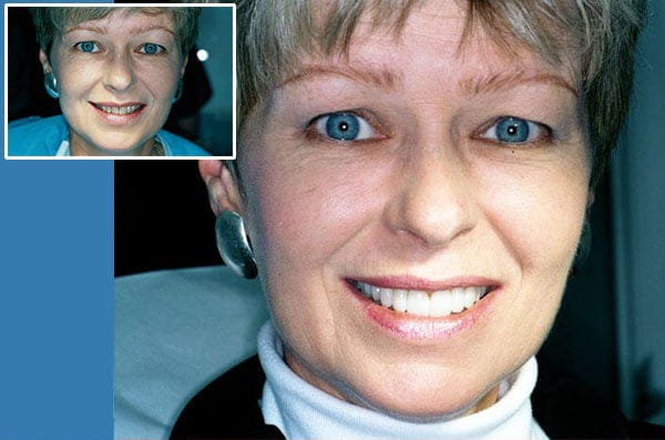 Before and after images of a woman's smile transformation dental treatment performed by Dr. Nottingham